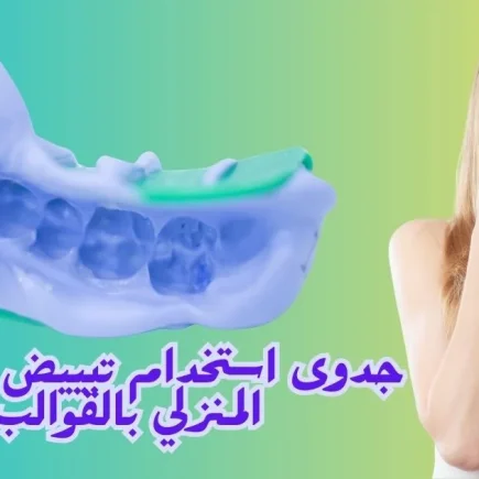 تبييض الأسنان المنزلي بالقوالب