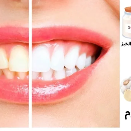 أفضل طرق تبييض الأسنان في المنزل