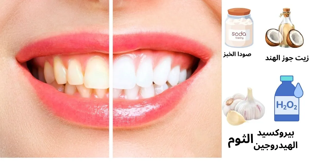 أفضل طرق تبييض الأسنان في المنزل