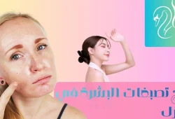 علاج التصبغات طبيعيا: 5 وصفات منزلية سهلة لتوحيد لون البشرة علاج التصبغات طبيعيا