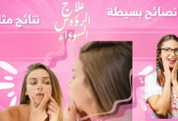 علاج الرؤوس السوداء للبشرة الدهنية: وصفات وخطوات مجربة علاج الرؤوس السوداء للبشرة الدهنية