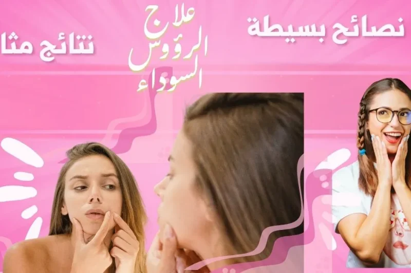 علاج الرؤوس السوداء للبشرة الدهنية