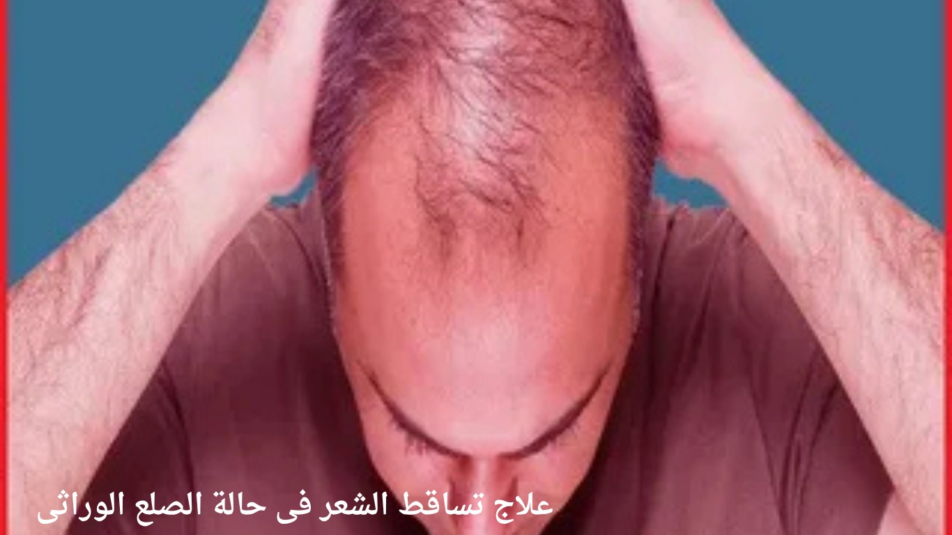 علاج تساقط الشعر: الأسباب وأفضل طرق العلاج والوصفات الطبيعية