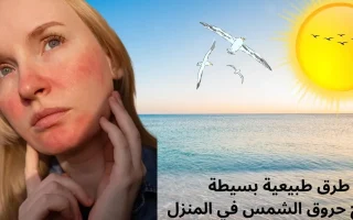 علاج حروق الشمس من البحر في المنزل