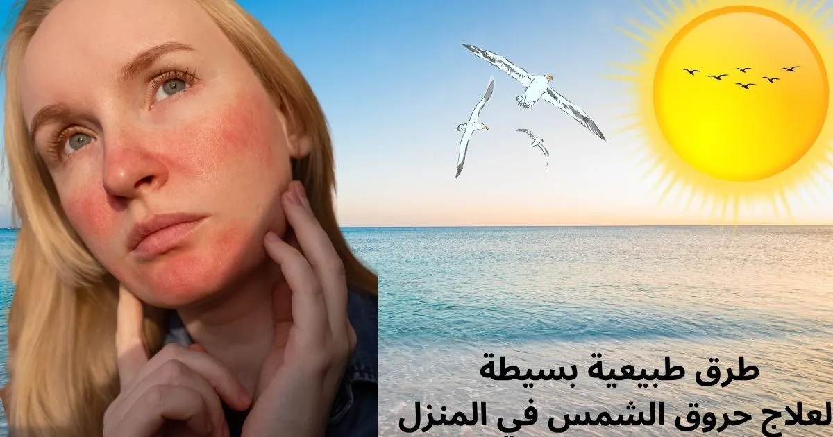 علاج حروق الشمس من البحر في المنزل