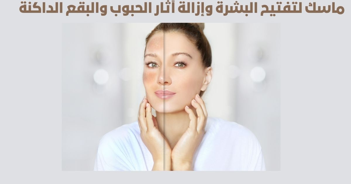 ماسك لتفتيح البشرة وإزالة آثار الحبوب والبقع الداكنة