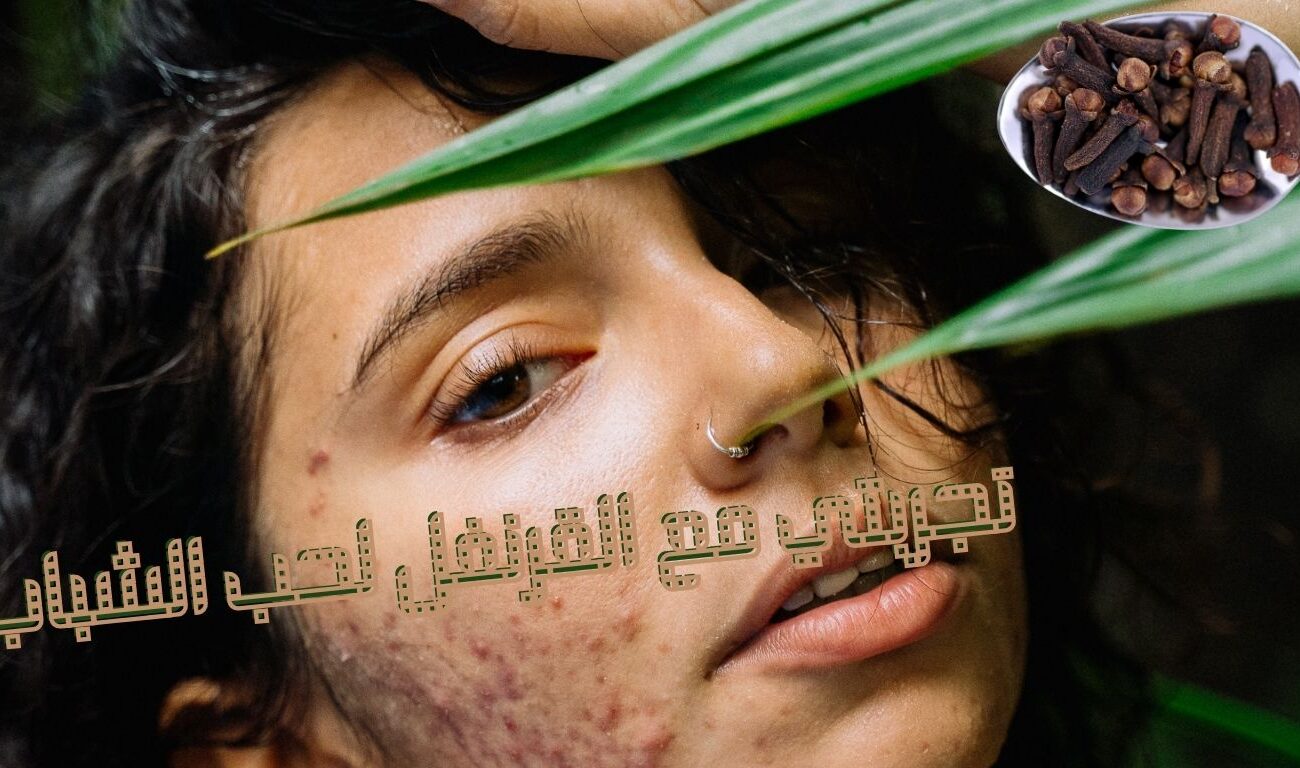 تجربتي مع القرنفل لحب الشباب في أسبوع وهل نجح معي؟ 