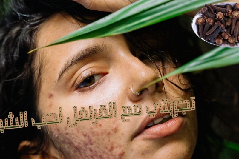 تجربتي مع القرنفل لحب الشباب