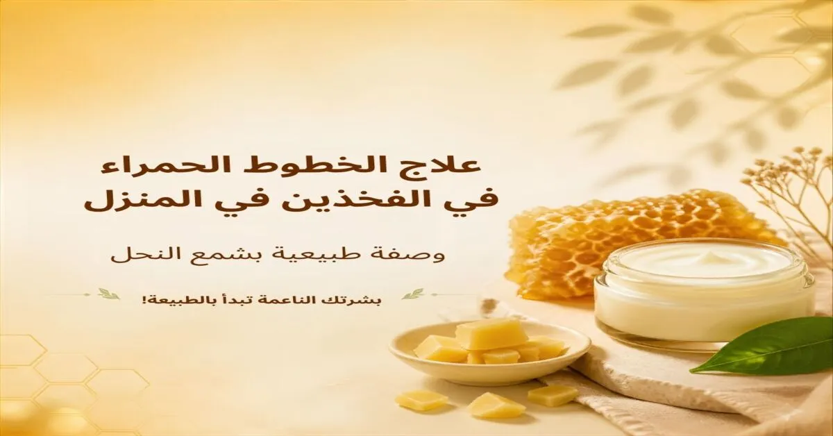 علاج الخطوط الحمراء في الفخذين في المنزل: وصفة طبيعية بشمع النحل